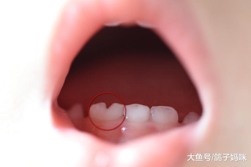 一颗还是两颗牙？你家宝宝也有这样的牙齿吗？