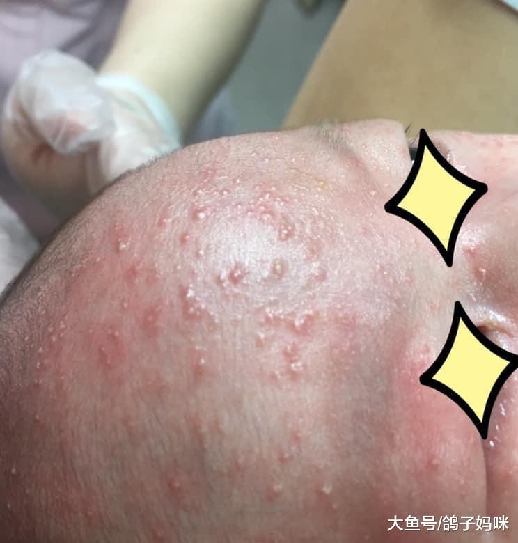 婴儿长绿头皮屑吓坏妈！医生提醒别乱抠