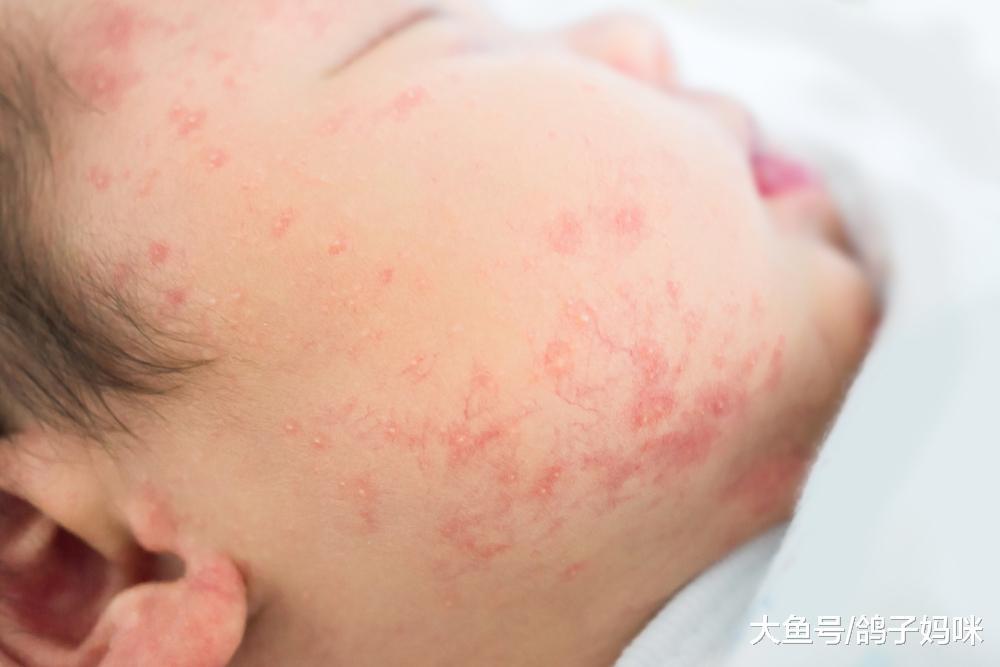 新生儿长痘痘，妈妈要做好清洁与护理的4大原则