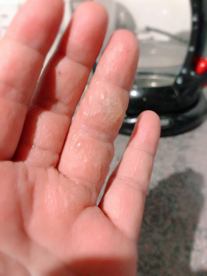为什么手上会长小水泡?是身体在暗示什么吗?一起了解一下