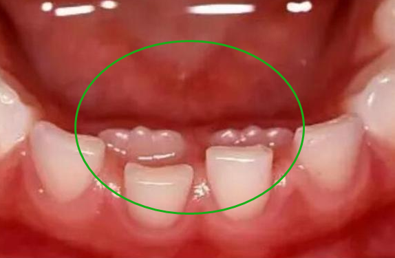 孩子长出“双排牙”? 儿科医生: 父母有很大关系, 别给孩子这样吃饭