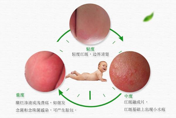 【新生儿红屁股的症状】