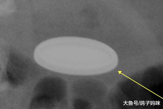 什么东西都往嘴巴塞，4岁女孩吞了这个险丧命