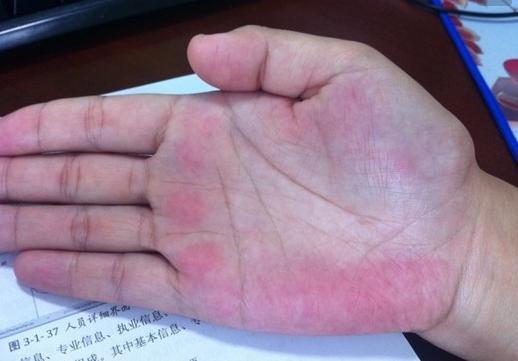 肝癌常常皮肤上会有四种变化, 十个人九个都会忽视, 最好去查一下