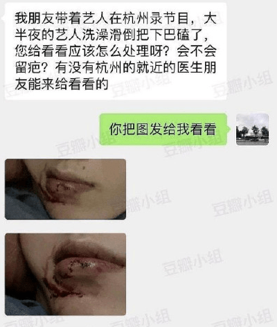 网曝范丞丞洗澡摔倒磕破下巴，受