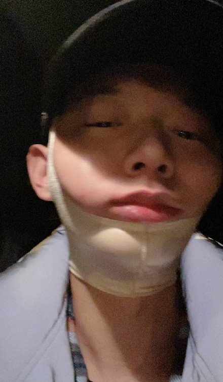 霍尊打哈欠致下巴脱臼后晒照报平安,脸部浮肿缠绷带不
