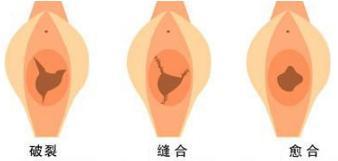 女性私密整形知多少?
