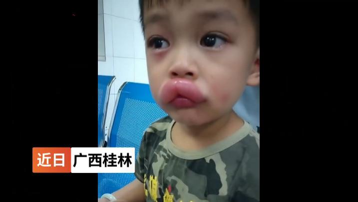 男孩吃葡萄过敏进医院：孩子食物过敏无小事，父母科学规避这么做