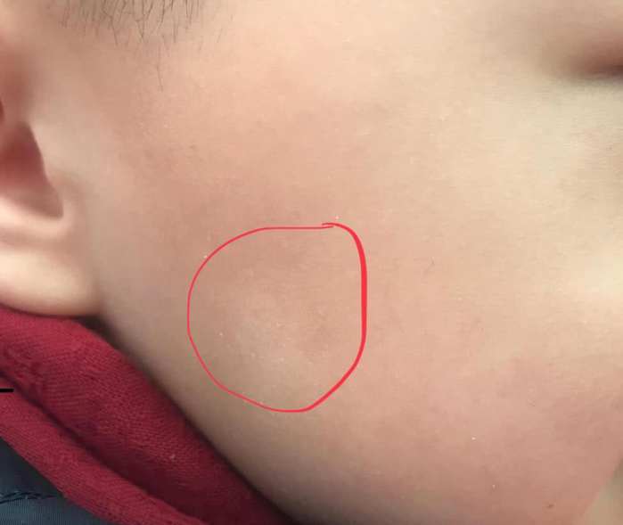 宝宝脸上的白斑是什么？

可能