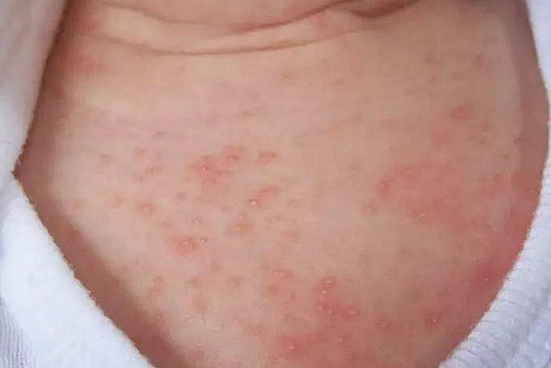 宝宝经常起热痱子，是缺什么东西