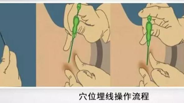 红豆|中医最方便的减肥法：穴位埋线法