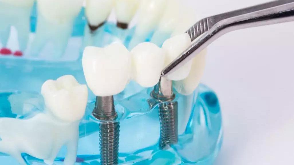 廊坊人想做种植牙，得满足几个要求