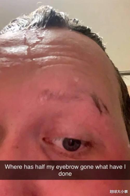 错把除毛膏当刮胡泡 澳洲男涂满全脸才知大事不妙 考拉海购