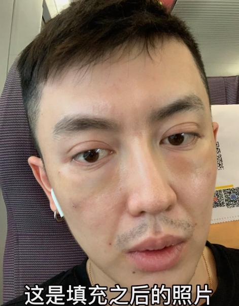 男网红整容变毁容,术后哭诉自己变老20岁,网友:前后对比没法看 男网红整容变毁容,术后哭诉自己变老20岁,网友:前后对比没法看