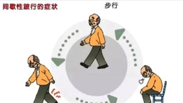 张医生科普|老年人无法正常走路，不是椎管狭窄惹的祸，大多是动脉血管堵塞了！