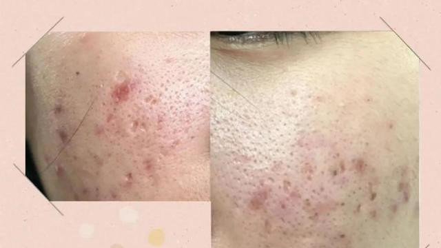 宋轶|宋轶用纯露敷脸2年，皮肤自带磨皮滤镜，网友：黑头、闭口的救星