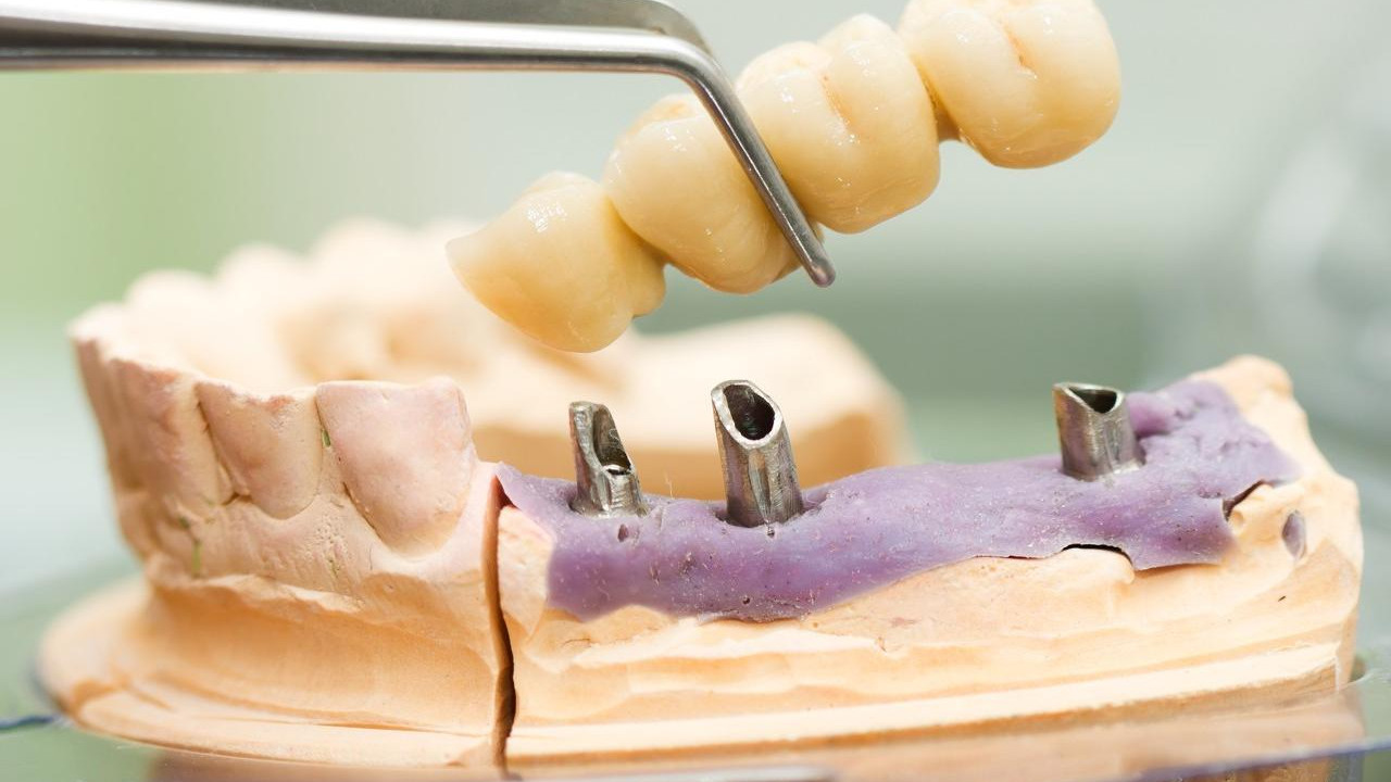 为什么廊坊人的种植牙费用不统一