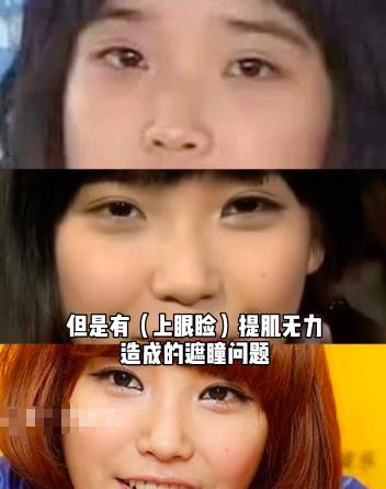 Iu疑似整容 Up主称其整容前很土 做完8项整容手术后美丽又自然 娱乐资讯 历史故事网
