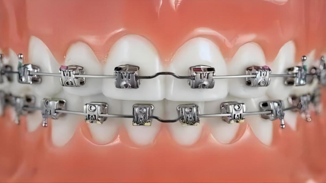 牙齿矫正|牙齿矫正需要多久？