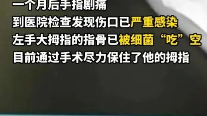 牧风芳华 男子大拇指被狗咬了，一个月后趾骨没了