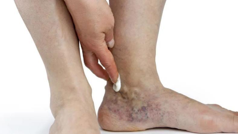 静脉曲张|「静脉溃疡案例11」起早贪黑操劳十多年，晚年脚小腿胀痛皮肤溃疡发黑难受不已