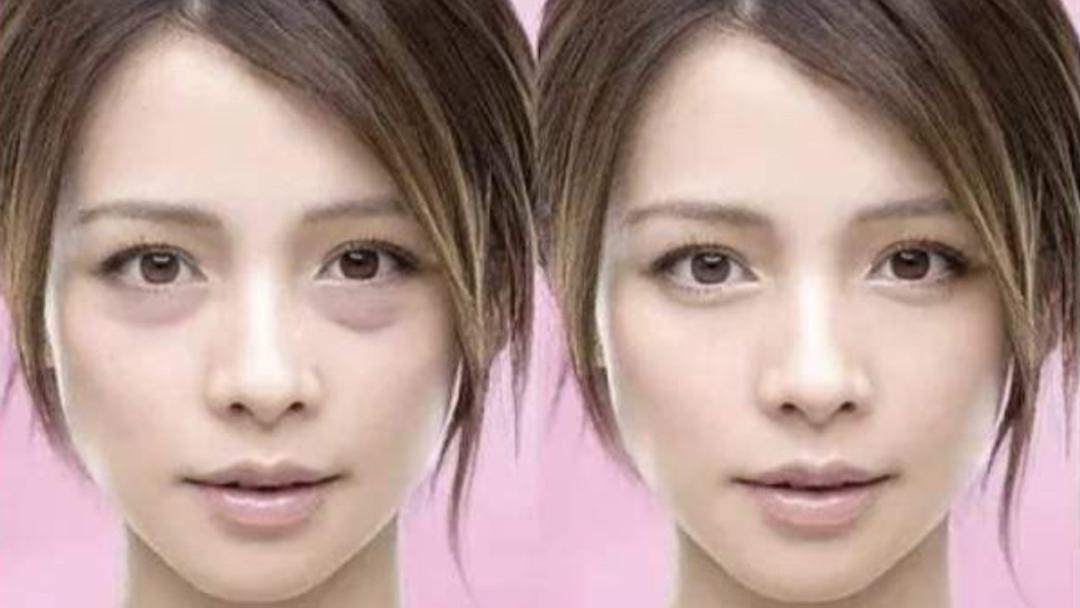 丁海峰|明星热衷割眼袋，有人立马年轻20岁，有人却僵到笑不出来