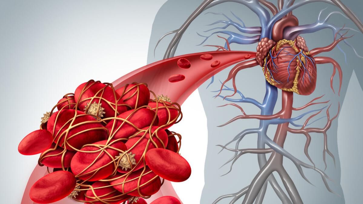 心房颤动|房颤患者预防脑梗，常用4个新型抗凝药，无须监测凝血，药效稳定