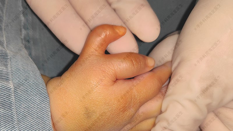 周海定：怀孕后住新装修的房子，患多指的概率会更高！