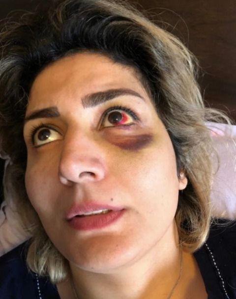 夫妻买别墅刚住进去，阳台塌了，妻子永久残疾