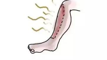 茶叶|为什么不建议老烂腿随意敷药？这个答案必须码住！