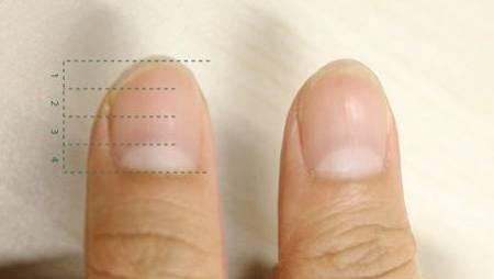 疫苗|半月痕只有大拇指有是怎么回事？