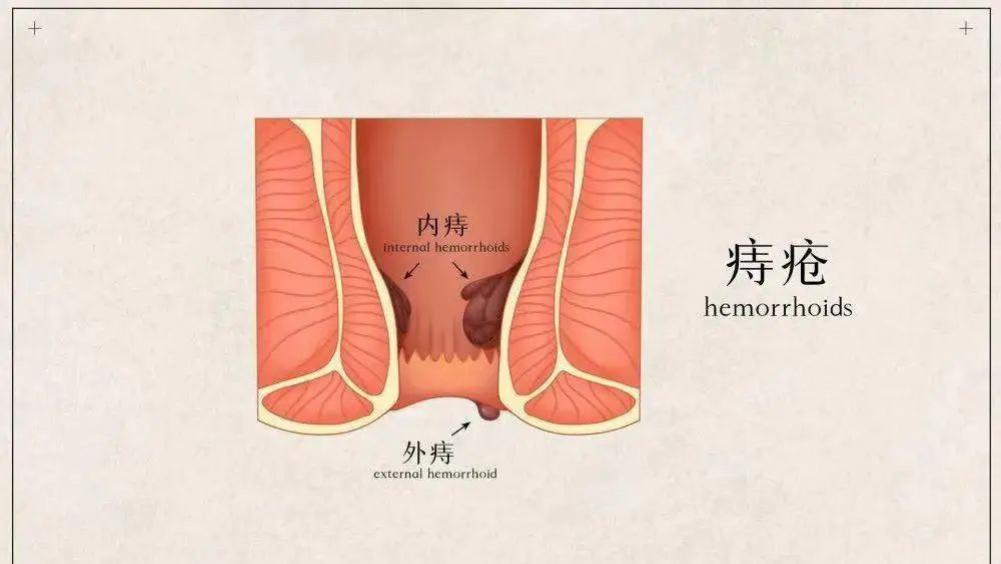 疾病|可怕！你的肛门健康是这样被一点一点消耗的