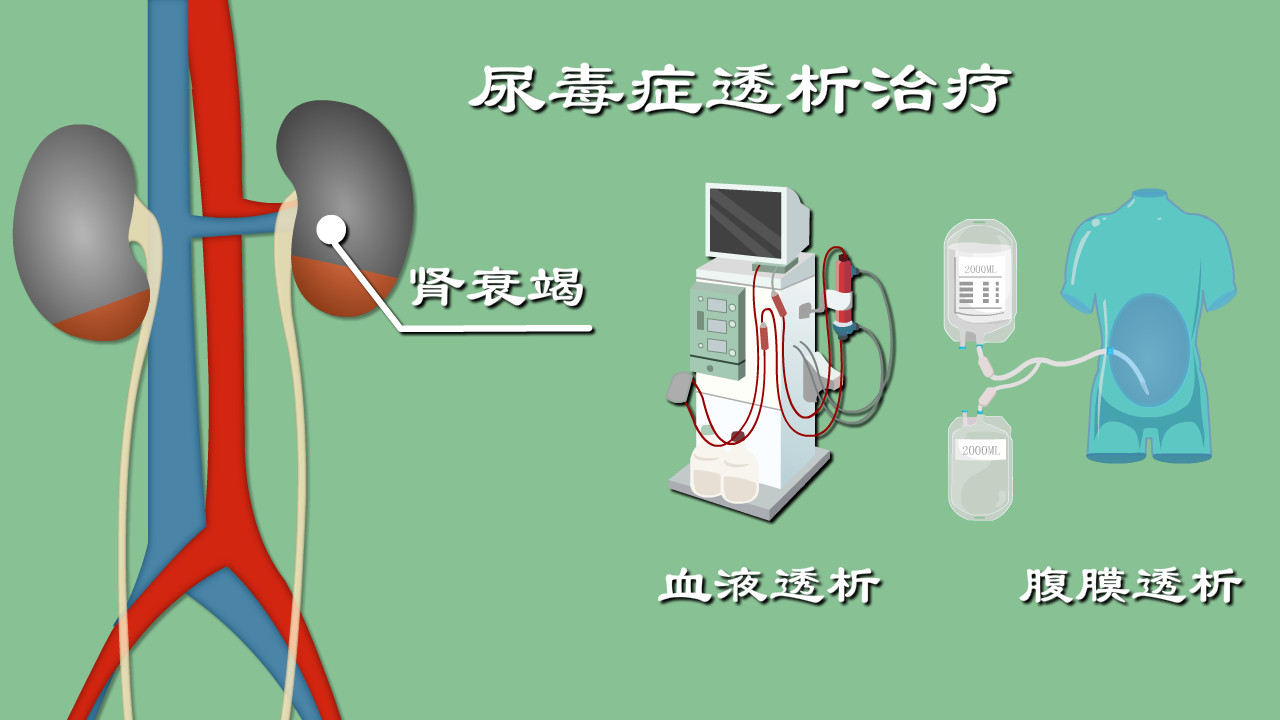 尿毒症|尿毒症只能透析保命？昏迷？心衰？透析有啥危险？走近透析真相
