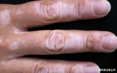 要怎么做才能从根本上预防白癜风疾病?做好这5点