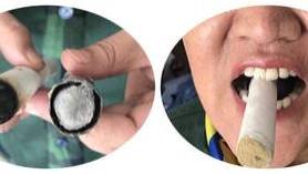 长寿|慢性咽炎火针治疗，最好结合体针