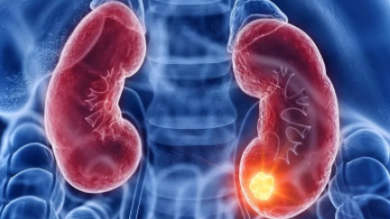 尿酸|数名专家呼吁：停止食用“1白2绿”，或是肾衰的“诱发剂”，趁早远离