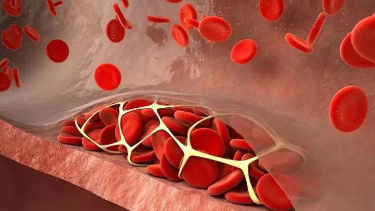 脑梗|脑梗“宿敌”被发现，54岁主任脑梗1年恢复，医生赞不绝口：厉害