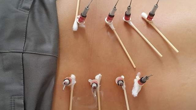 医生|火针并不是所有人都可以扎得准确到位