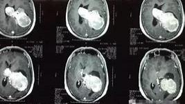 胆固醇|浅谈脑肿瘤治疗误区