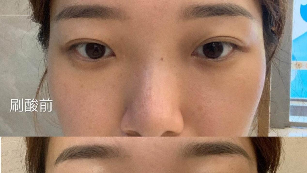 运动员 教你懂的得怎么刷酸！正确护肤不长痘！