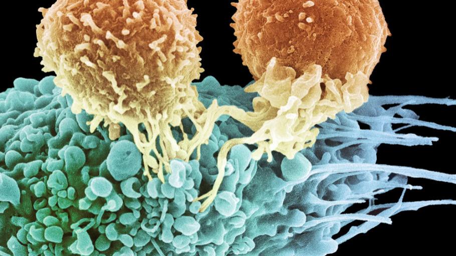 肾结石|癌症将死之人，每天喝“它”杀死大量癌细胞成功抗癌