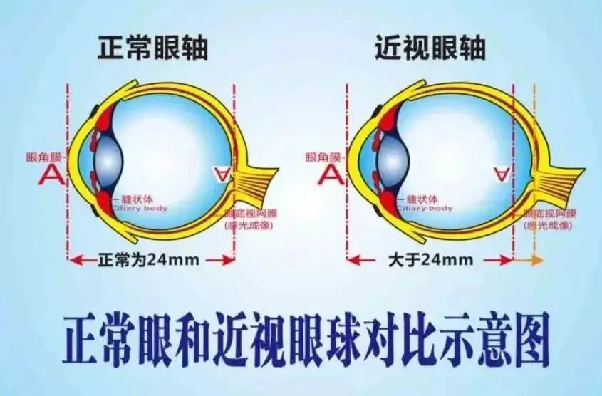 春节后想做近视手术？这些“内幕”必须了解！