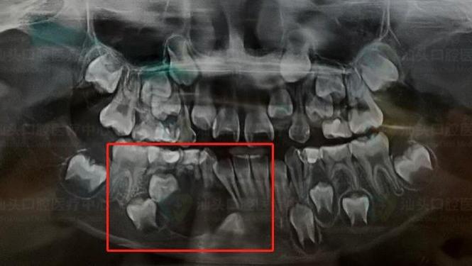 脱发|8岁男孩牙龈长鼓包！医生提醒，根尖囊肿可能导致拔牙