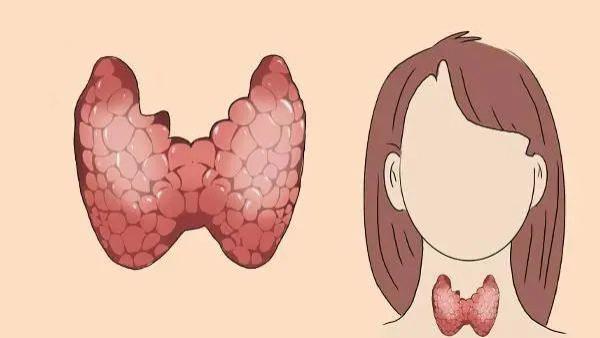 高血压|生姜+花椒泡脚一个月，结节患者都说好