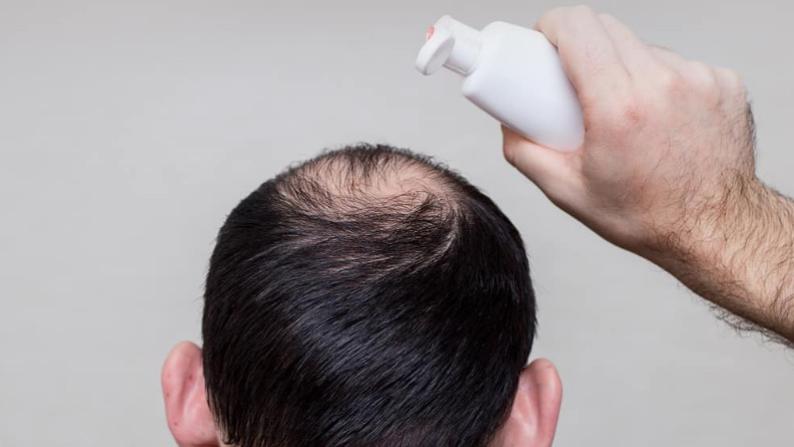 脱发|“米诺地尔”治脱发有副作用？哪些人不能用？不妨收藏以便查看