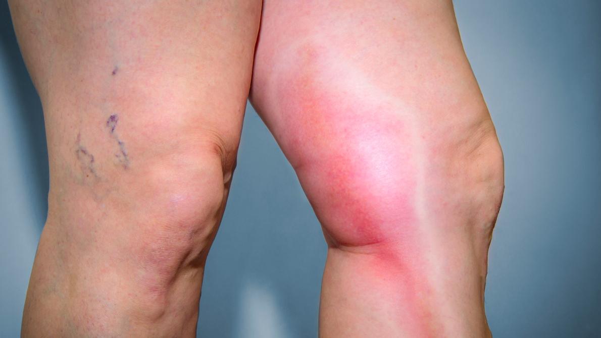 肛周脓肿|秋冬季节血管更加脆弱，专家提醒：注意防护，避免患上深静脉血栓！