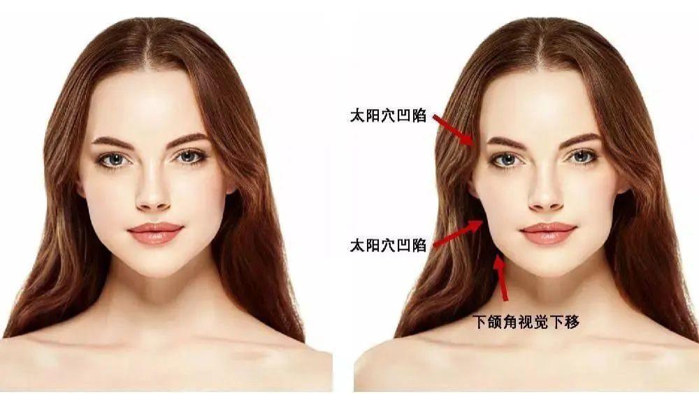 牙齿|戴完牙套反而变丑了，牙套脸真的不可逆吗？