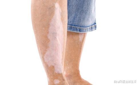 要怎么做才能从根本上预防白癜风疾病?做好这5点