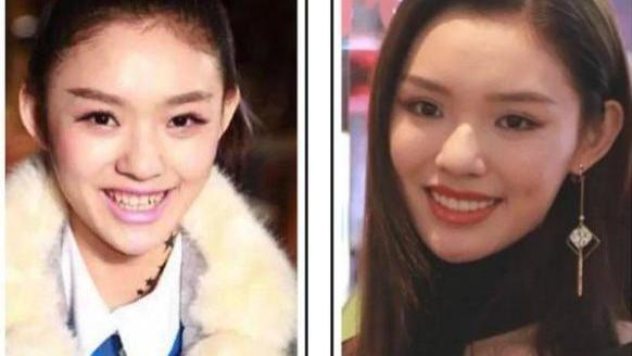 王嘉尔|王嘉尔近照嘴巴抢镜，整牙后遗症明显遭吐槽，网友：回不去了