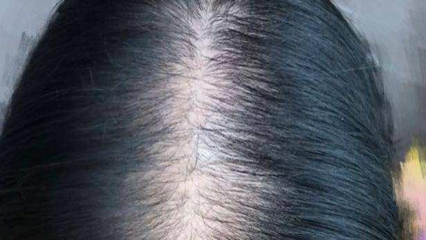 衰老|发量暴增攻略，头皮护理干货！快来长头发